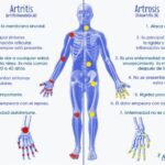 7 diferencias entre osteoartritis y artritis reumatoide