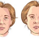 7 diferencias entre parálisis de Bell y cerebral