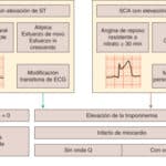 Diferencias entre infarto miocárdico y angina estable