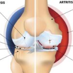 Gota vs Osteoartritis: Descubre las 5 diferencias esenciales